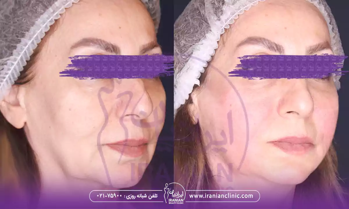 بهترین دکتر اندولیفت در شمال تهران