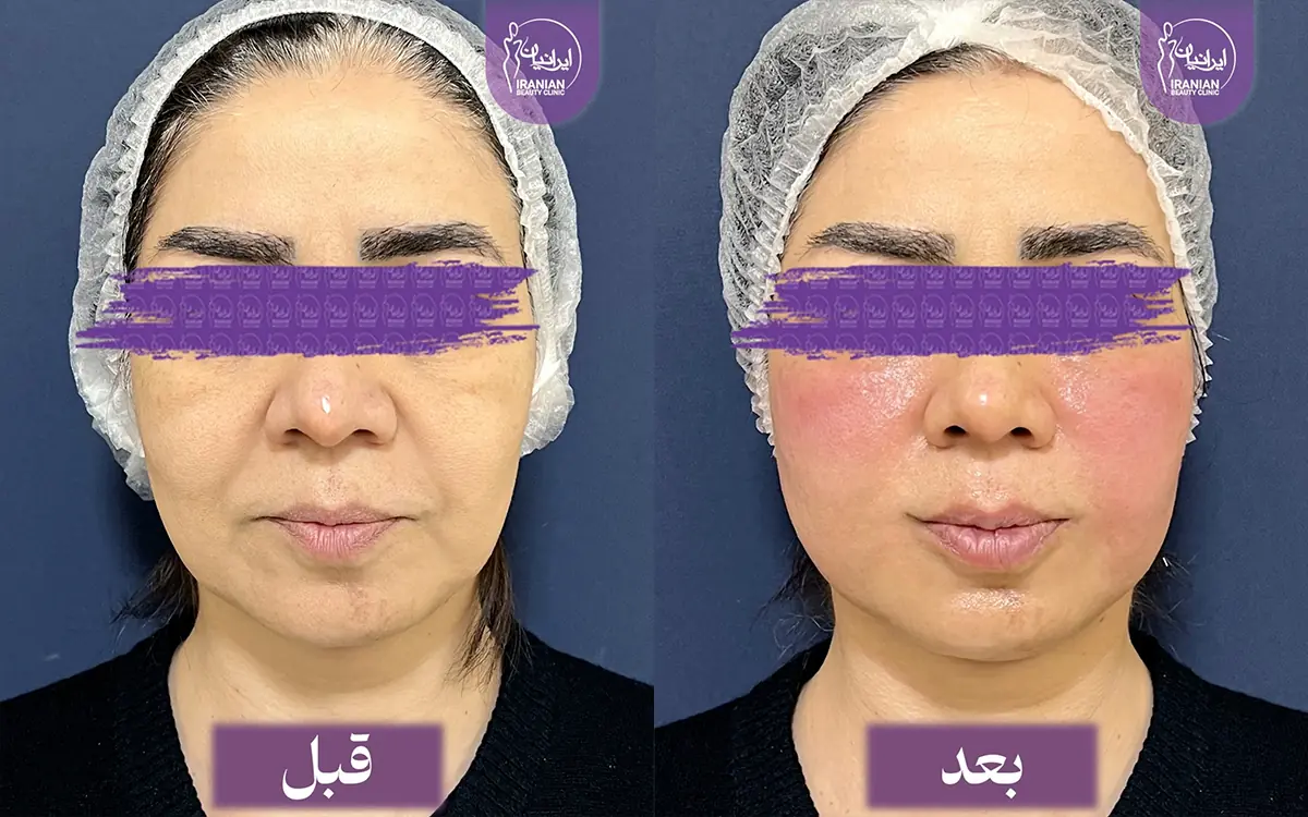 عکس قبل و بعد اندولیفت با بهترین دکتر اندولیفت کلینیک ایرانیان