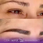 میکرو کاشت ابرو چیست؟