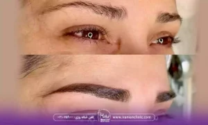 میکرو کاشت ابرو چیست؟