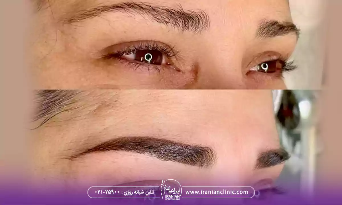 میکرو کاشت ابرو چیست؟