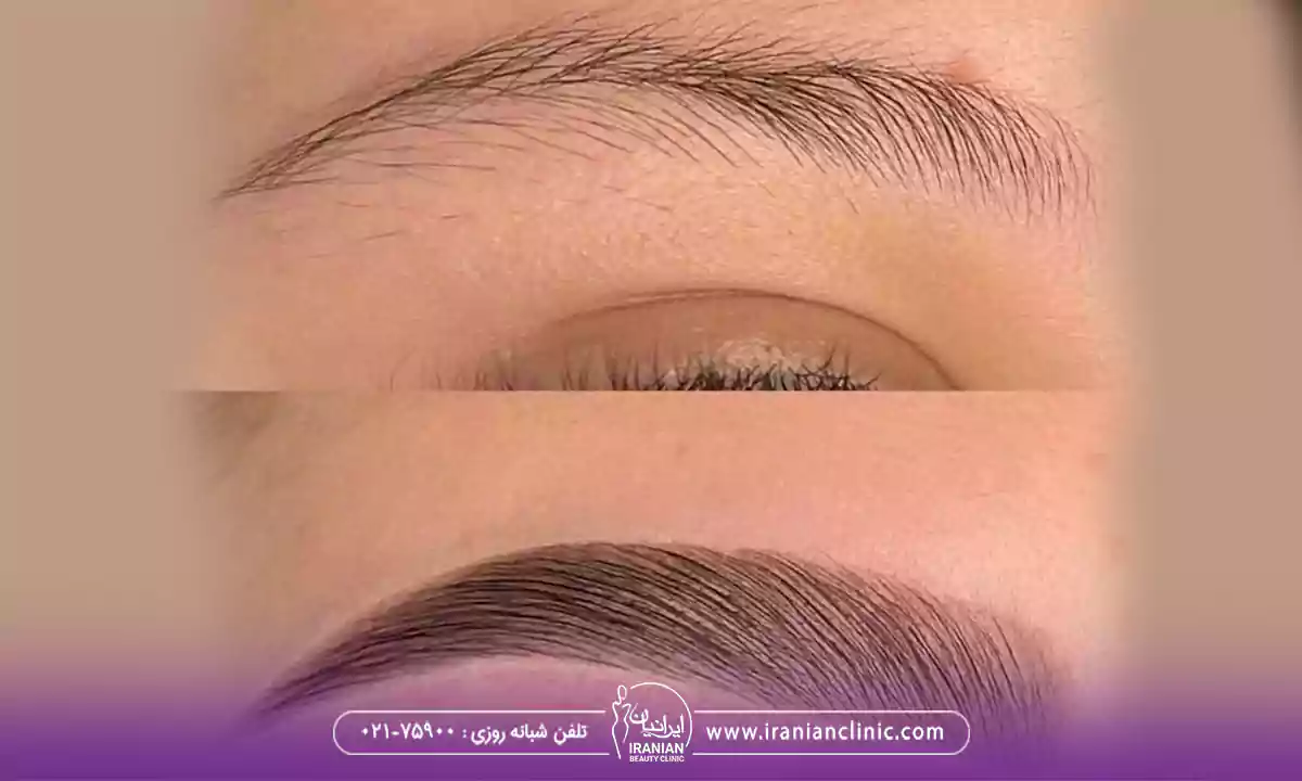 میکرو کاشت ابرو بهتر است یا میکروبلیدینگ؟