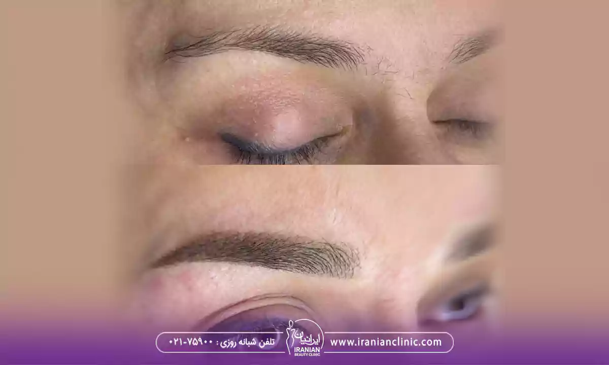 ظاهر میکرو کاشت ابرو چگونه طبیعی می شود؟