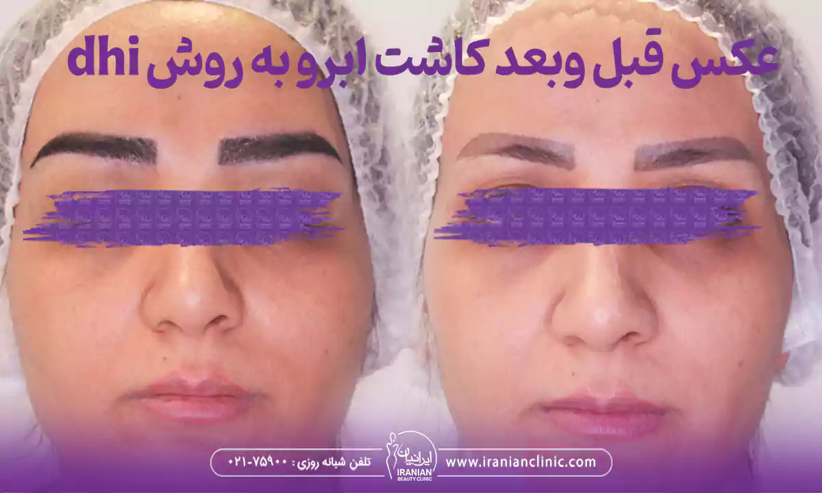 عوامل مؤثر بر هزینه کاشت ابرو به روش DHIو عکس قبل و بعد کاشت ابرو dhi