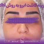 eyebrow-transplant-dhi-price