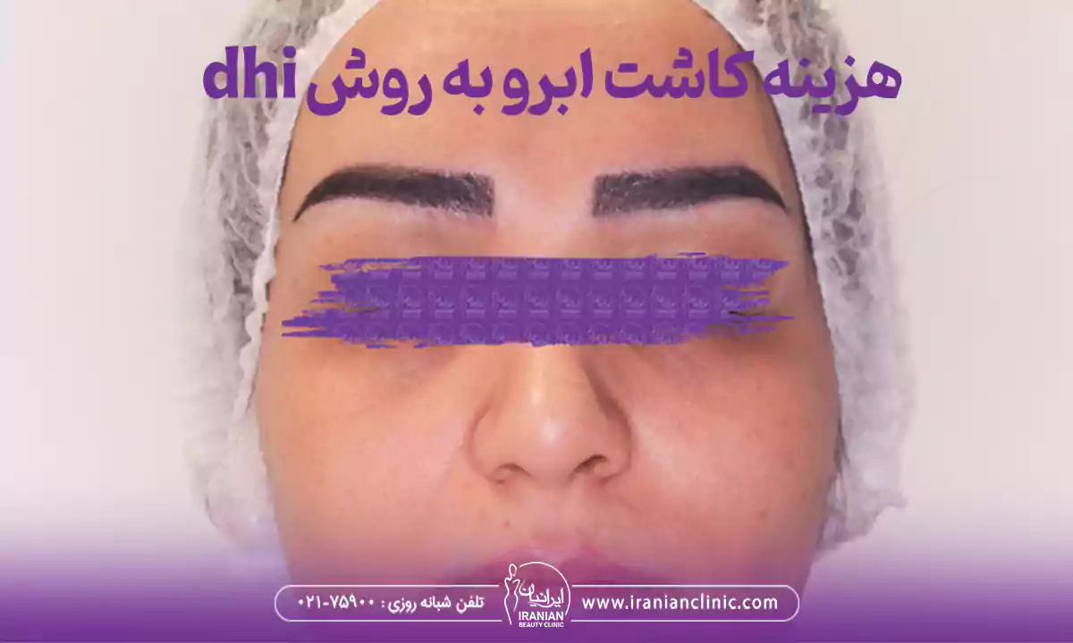 قیمت کاشت ابرو به روش dhi و هزینه کاشت ابرو به روش DHI