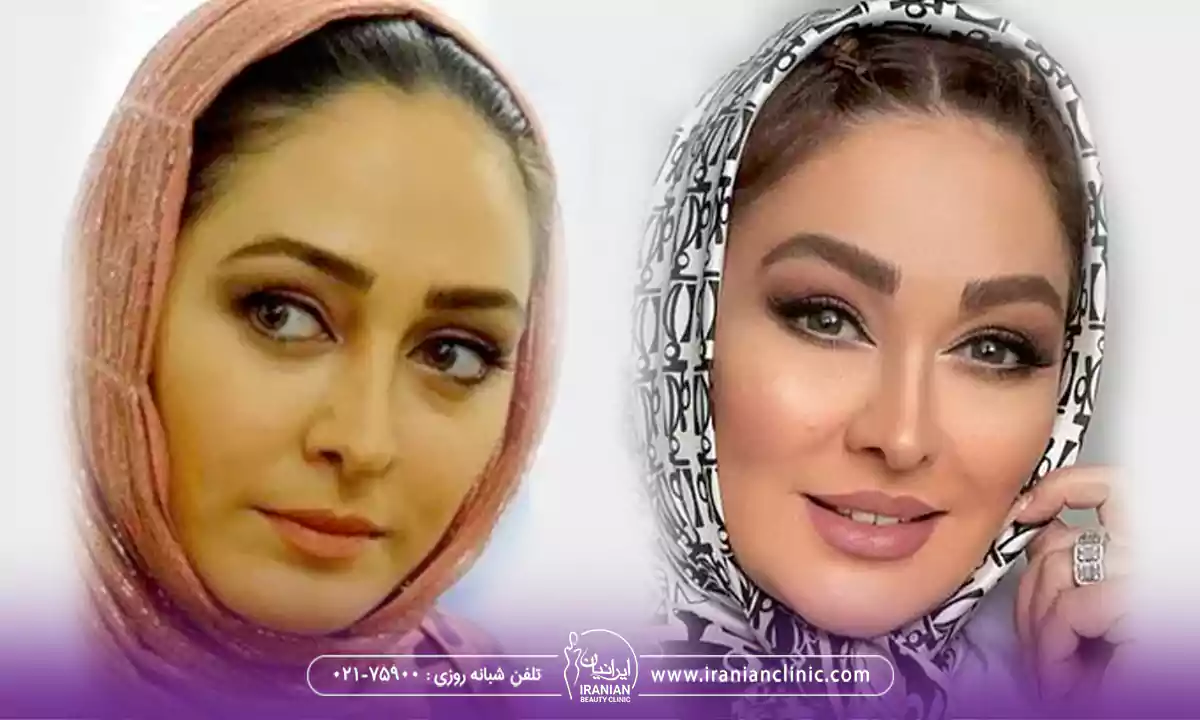 کاشت ابرو بدون جراحی به روش سلبریتی متد الهام حمیدی