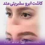 کاشت ابرو بدون جراحی به روش سلبریتی متد