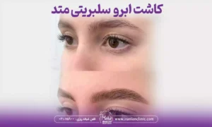 کاشت ابرو بدون جراحی به روش سلبریتی متد