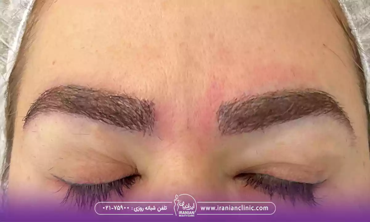 عوامل موثر بر هزینه کاشت ابرو دخترانه