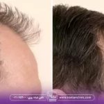هزینه کاشت مو به روش بایوفایبر و قیمت کاشت مو به روش بایوفایبر