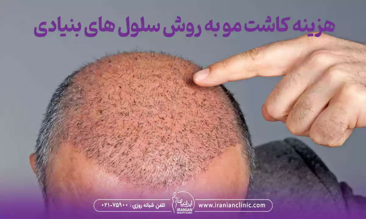 عوامل مؤثر بر هزینه کاشت مو سلول های بنیادی