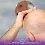 قیمت کاشت مو به روش سلول های بنیادی و هزینه کاشت مو به روش سلول های بنیادی