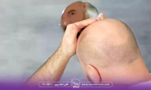 قیمت کاشت مو به روش سلول‌ های بنیادی و هزینه کاشت مو به روش سلول‌ های بنیادی