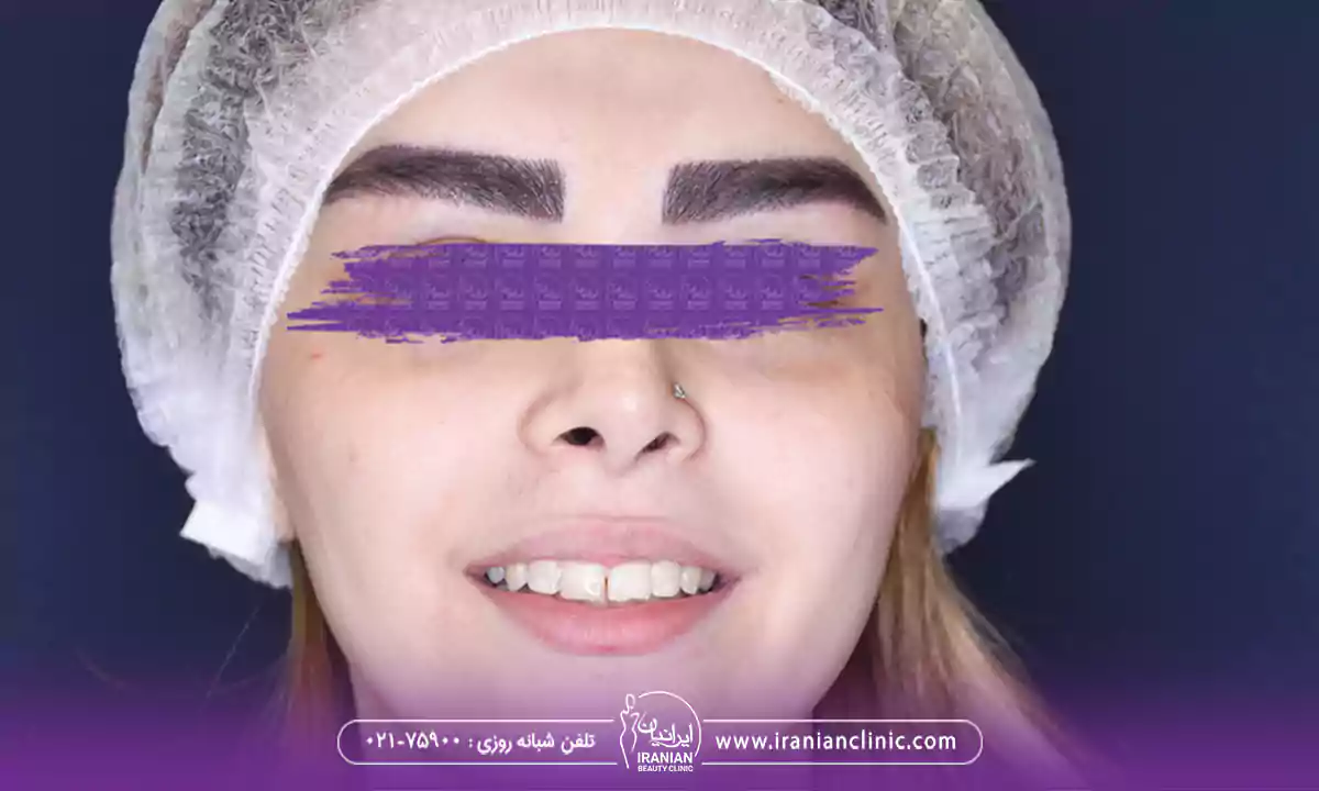 عکس قبل و بعد کاشت با بهترین دکتر کاشت ابرو دخترانه تهران