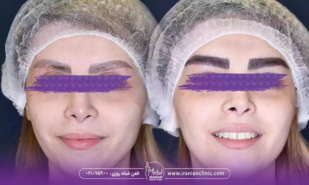 انواع روش های کاشت ابرو دخترانه طبیعی، عکس قبل و بعد کاشت ابرو دخترانه نچرال