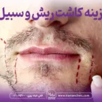هزینه کاشت ریش و سبیل در تهران و قیمت کاشت ریش و سبیل تهران
