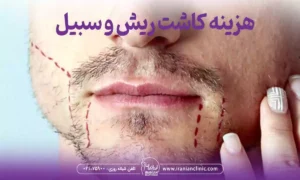 هزینه کاشت ریش و سبیل در تهران و قیمت کاشت ریش و سبیل تهران