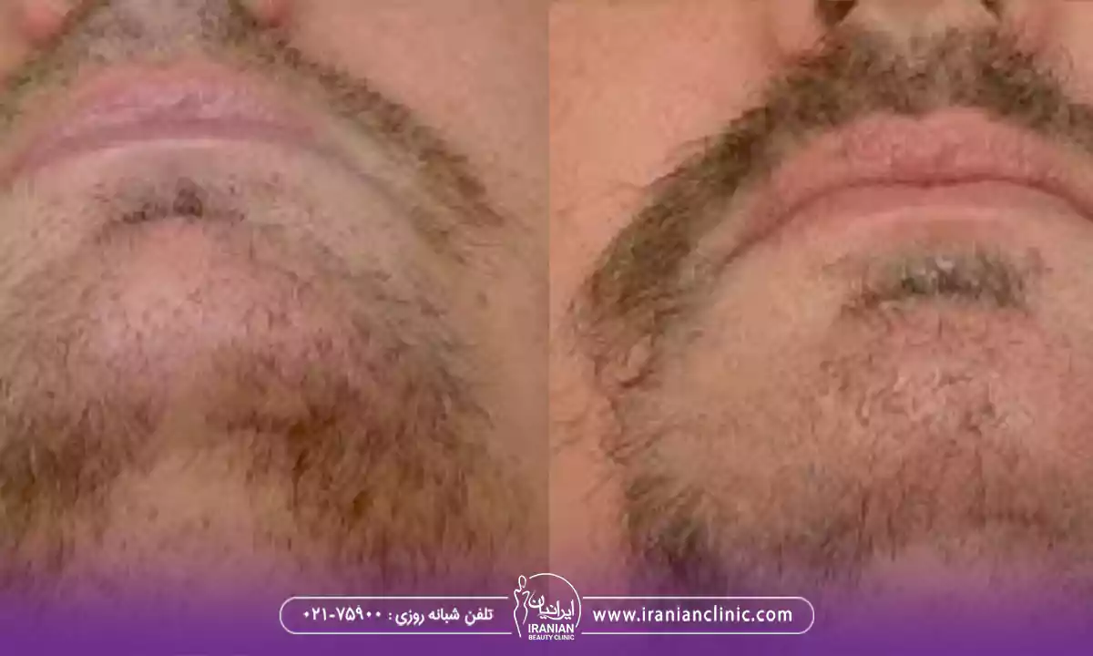 هزینه کاشت ریش و سبیل در تهران به روش های مختلف