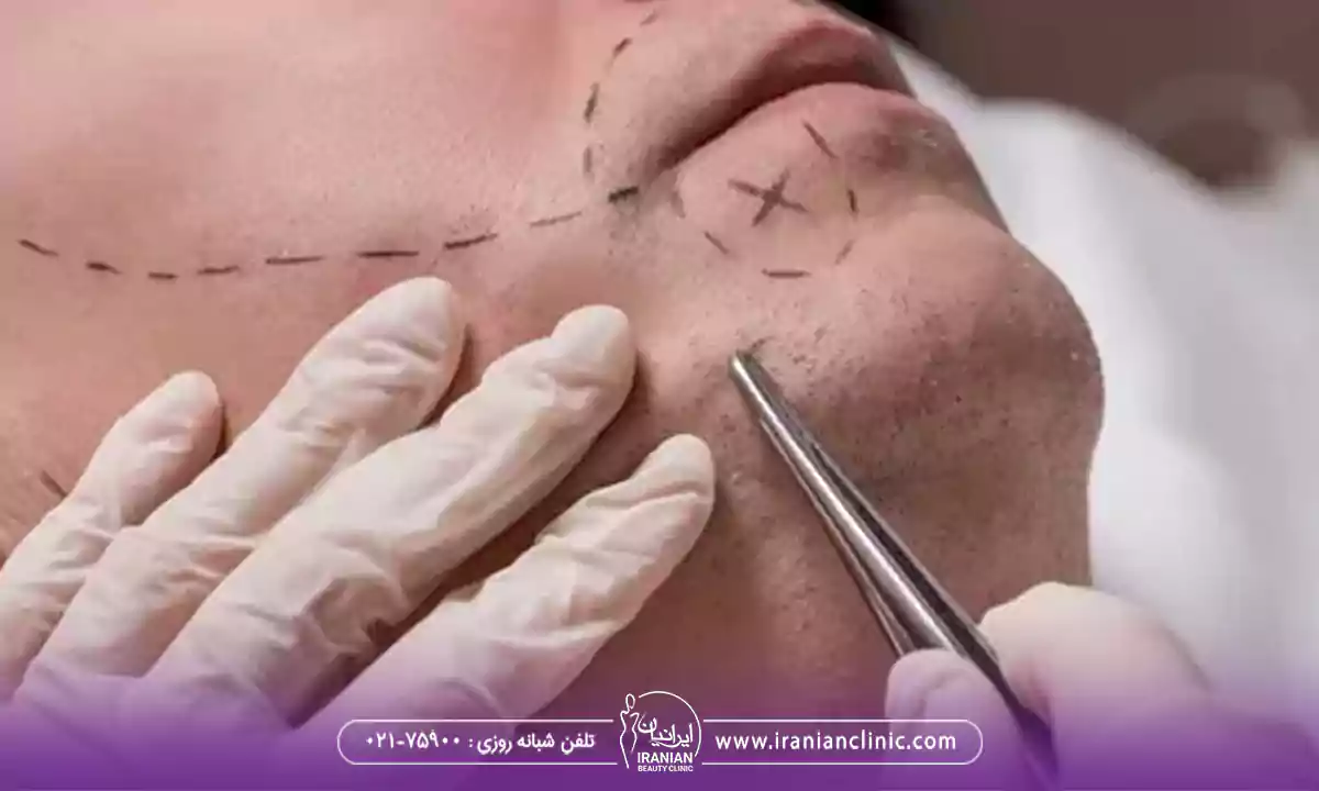 عوامل موثر بر هزینه کاشت ریش و سبیل در تهران