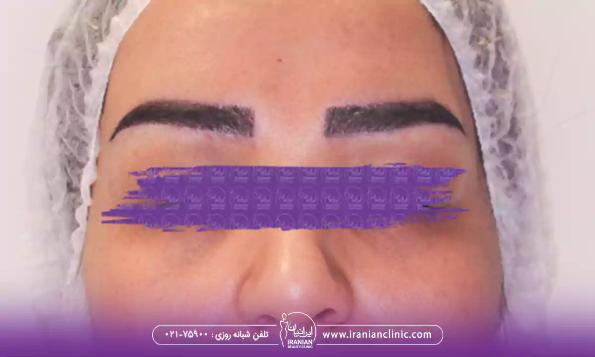 کاشت ابرو طبیعی عکس بعد