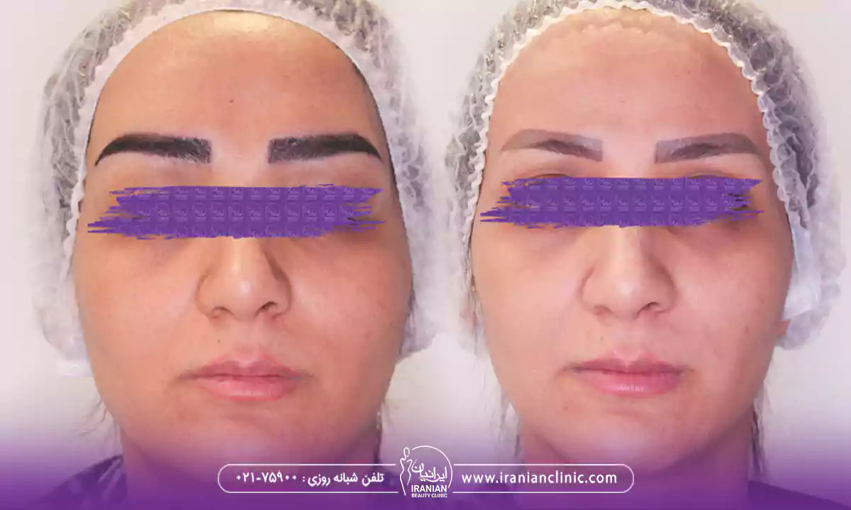 تصاویر کاشت ابرو طبیعی و نمونه کاشت ابرو نچرال در کلینیک ایرانیان