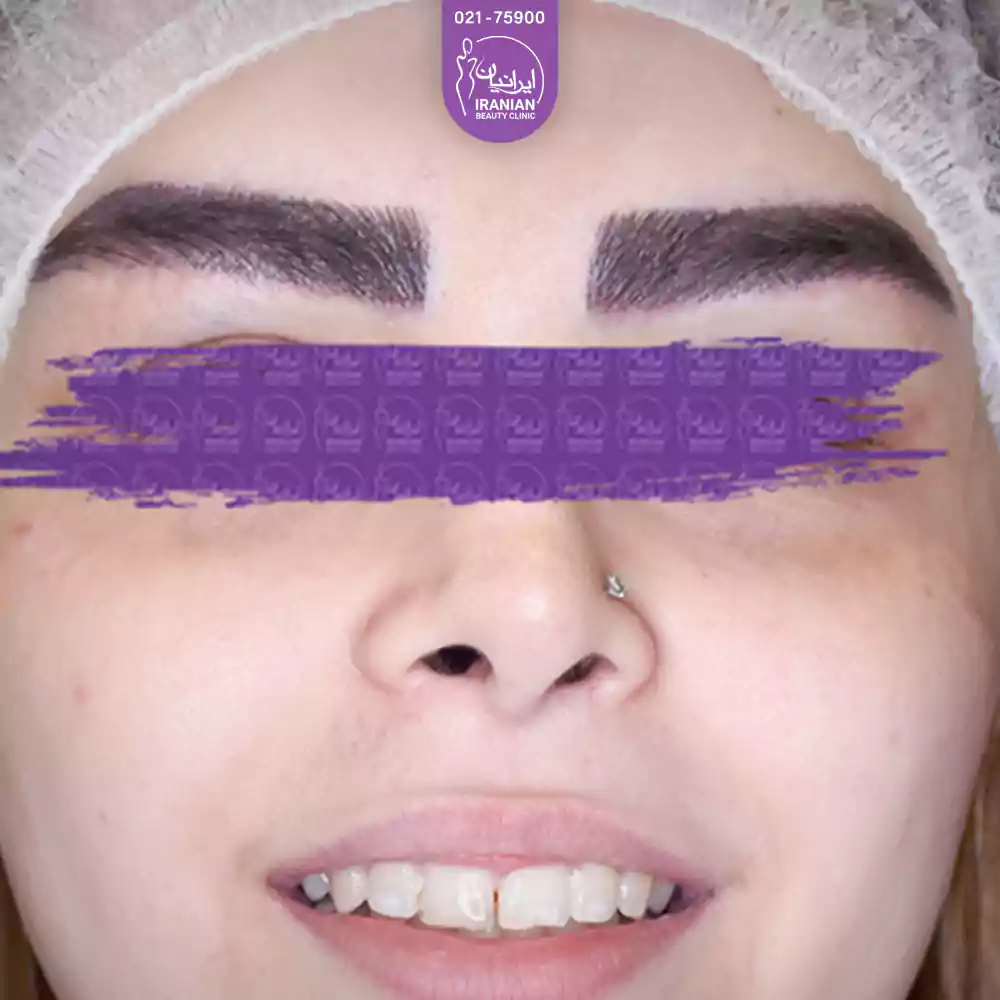 کاشت ابرو طبیعی و کاشت طبیعی ابرو نچرال