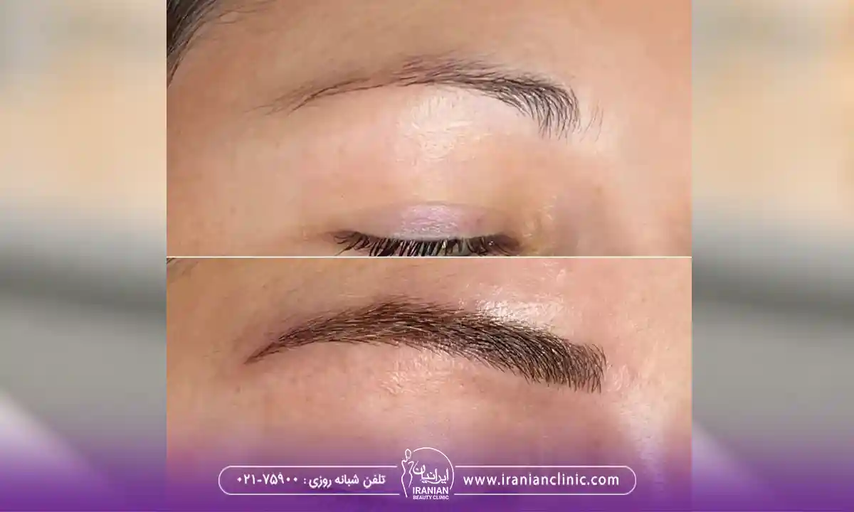 هزینه کاشت در بهترین مرکز کاشت طبیعی ابرو