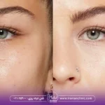 cat-eye-botox-before-and-after