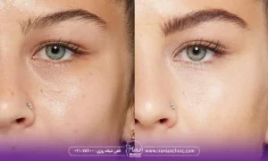 cat-eye-botox-before-and-after