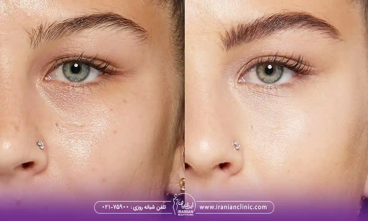 بوتاکس چشم گربه ای قبل و بعد