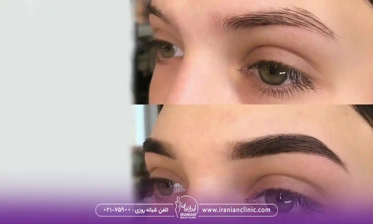 مرکز برای کاشت ابرو طبیعی