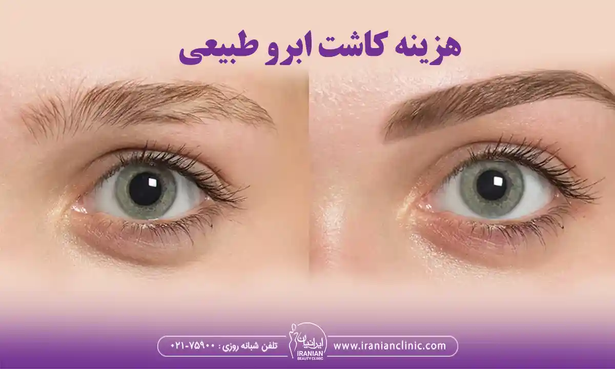 عوامل مؤثر بر هزینه کاشت ابرو طبیعی