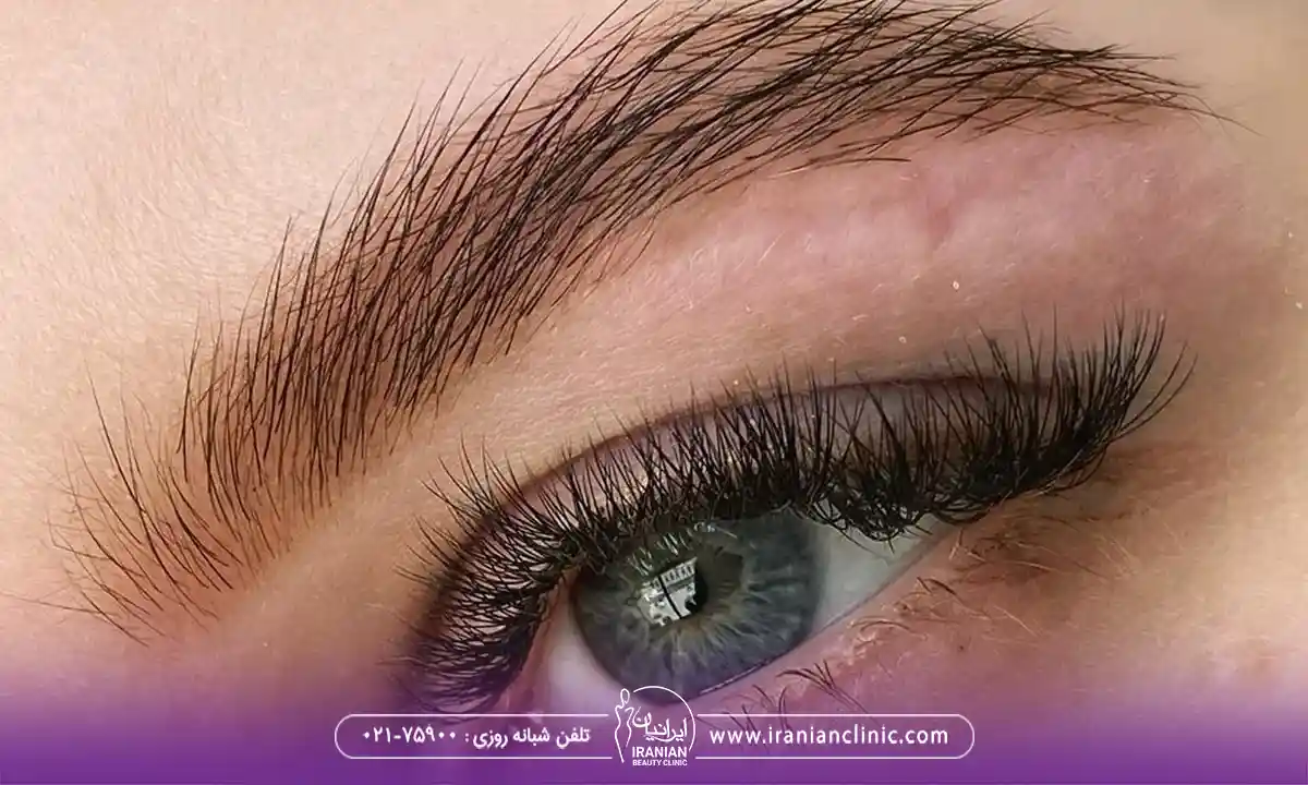 هزینه کاشت ابرو طبیعی در کلینیک ایرانیان