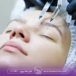کاشت ابرو با موی دیگران چگونه انجام می شود