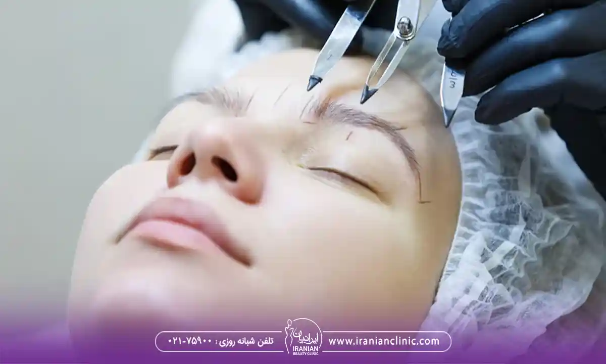 کاشت ابرو با موی دیگران چگونه انجام می شود