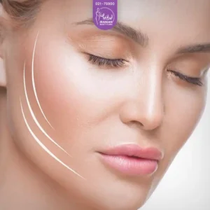 کات گونه با تزریق فیلر