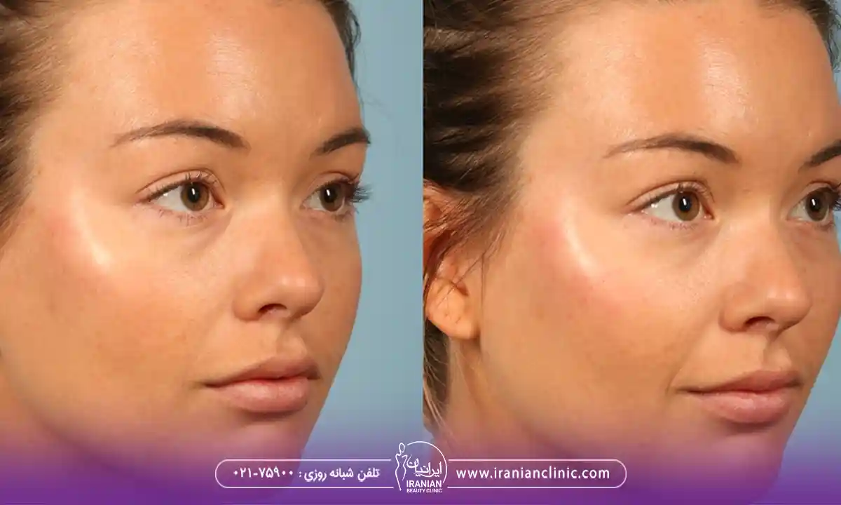نحوه تزریق کات گونه با فیلر