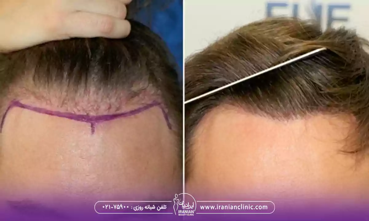 مزایای کاشت مو به روش بایوفایبر