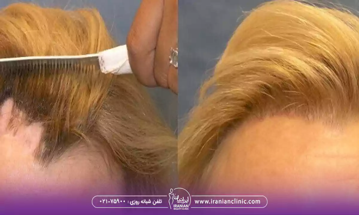 کاشت مو به روش بایوفایبر چیست؟