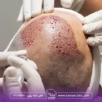 مشاوره کاشت مو و مشاوره آنلاین کاشت مو اینترنتی و تلفنی