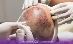 مشاوره کاشت مو و مشاوره آنلاین کاشت مو اینترنتی و تلفنی