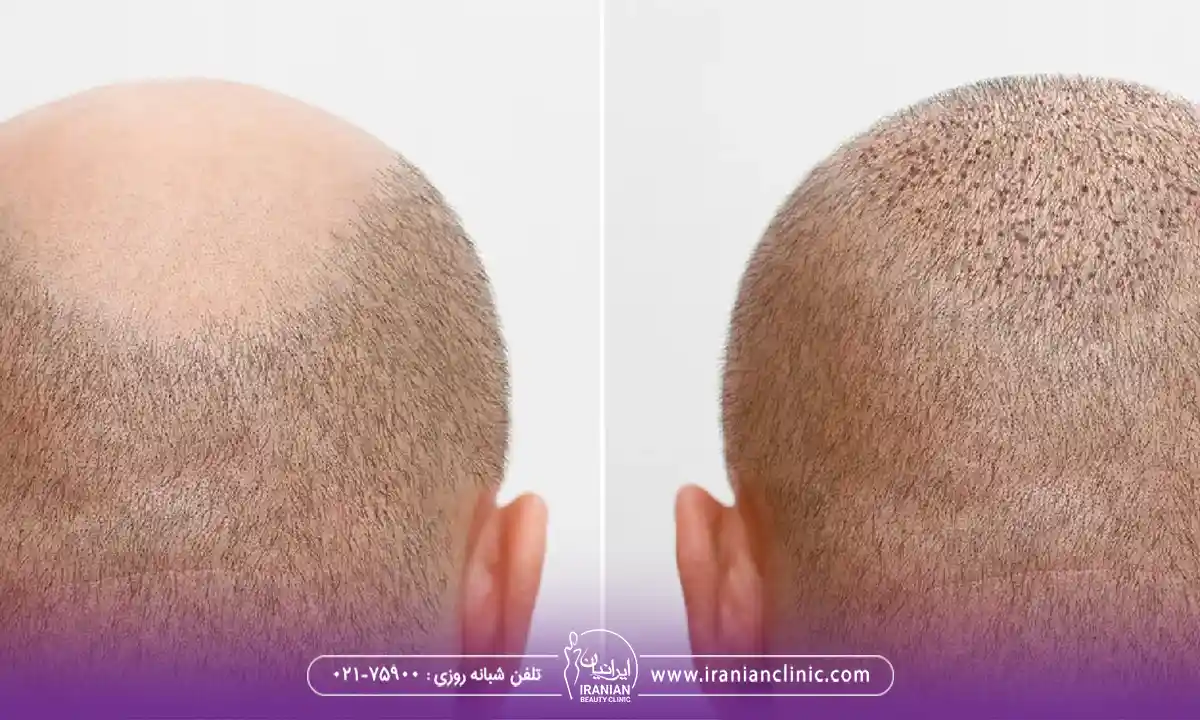 نحوه رزرو نوبت و مشاوره آنلاین کاشت مو