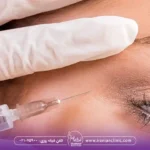 نقاط تزریق بوتاکس چشم گربه ای