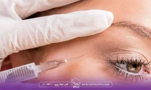 نقاط تزریق بوتاکس چشم گربه ای