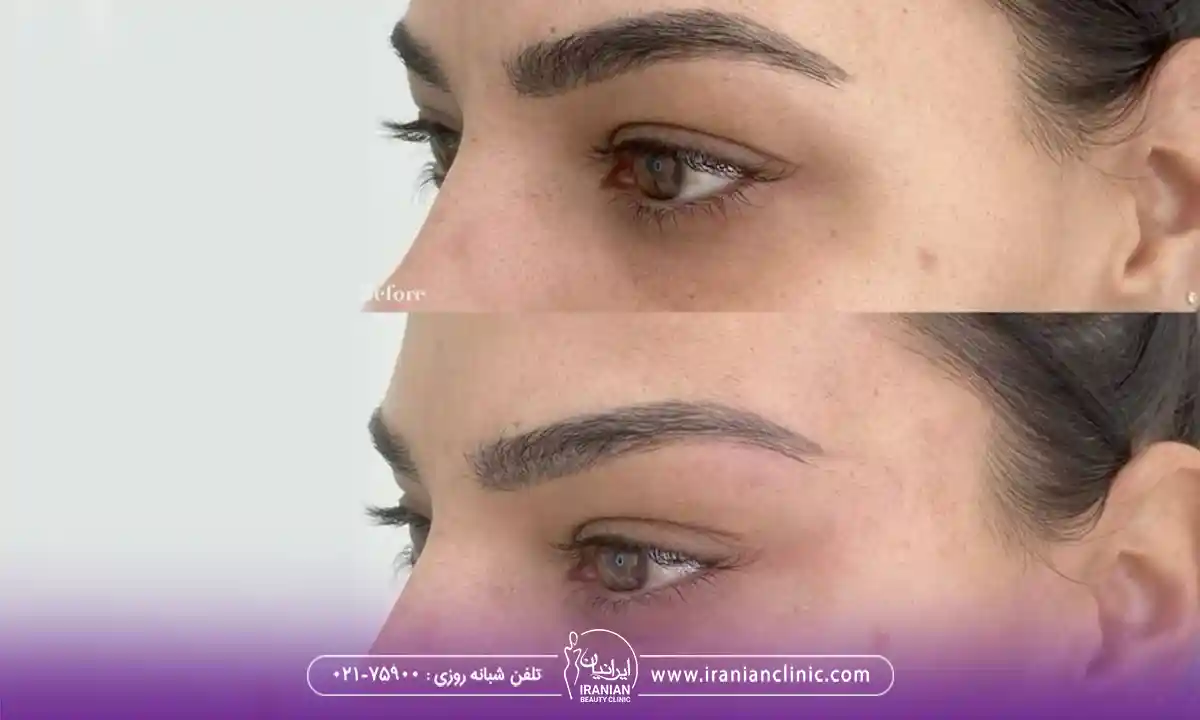تنظیم تقارن چشم ها با تزریق بوتاکس چشم گربه ای