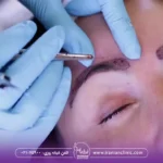 طریقه خوابیدن بعد از کاشت ابرو