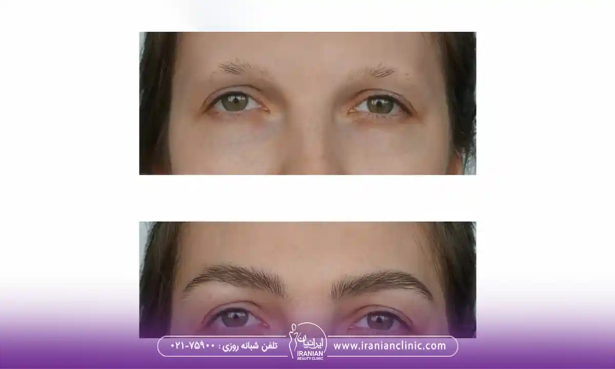 بهترین طریقه خوابیدن بعد از کاشت ابرو چگونه است؟