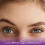چند روز بعد از بوتاکس ابرو بالا میره؟