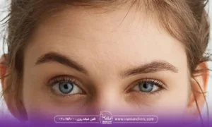 چند روز بعد از بوتاکس ابرو بالا میره؟
